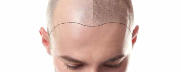 Scalp Micropigmentation