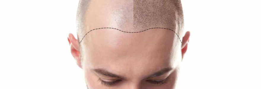 Scalp Micropigmentation