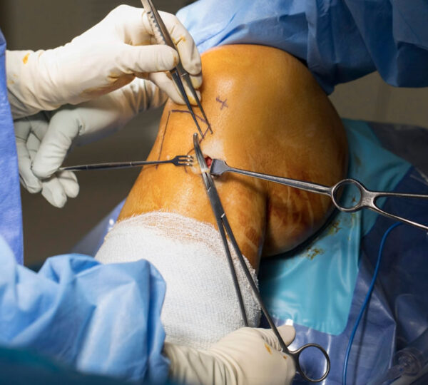 Anterior Cruciate Ligament