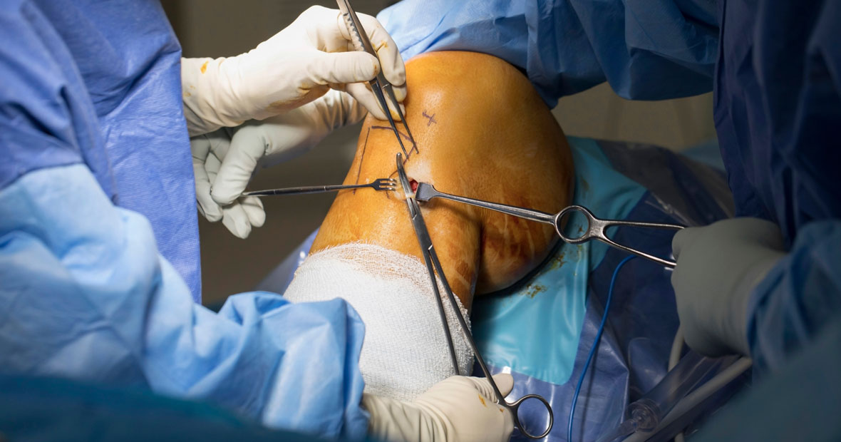 Anterior Cruciate Ligament